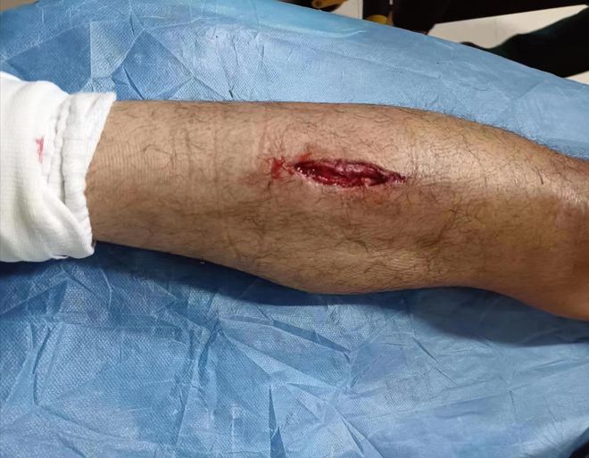 古墩路灯彩街 河南小伙冲进爆燃现场救人：路过却主动参与救人